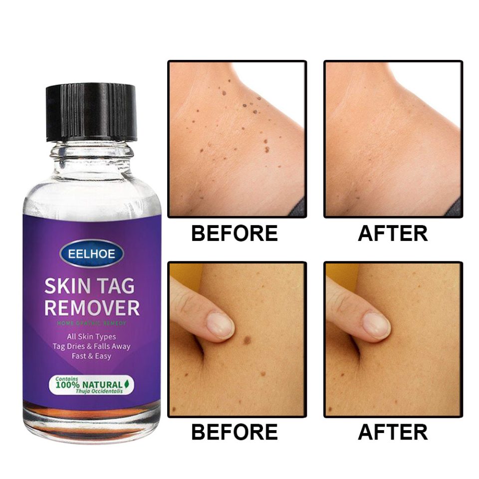 Eelhoe Wart Removal - International Trade Approved